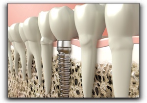 Knoxville dental implants