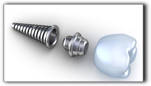 West Knoxville tooth implants cost Dental Implants in Knoxville
