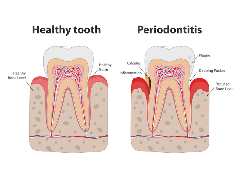 treatment for bleeding gums West Lenoir City