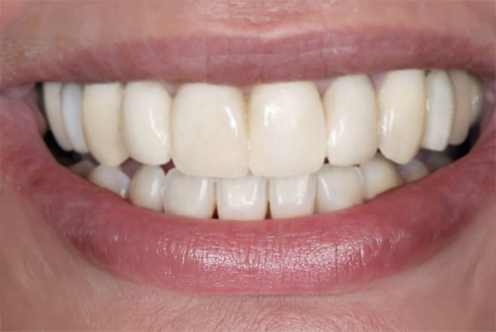 smile gallery after treatment case 1