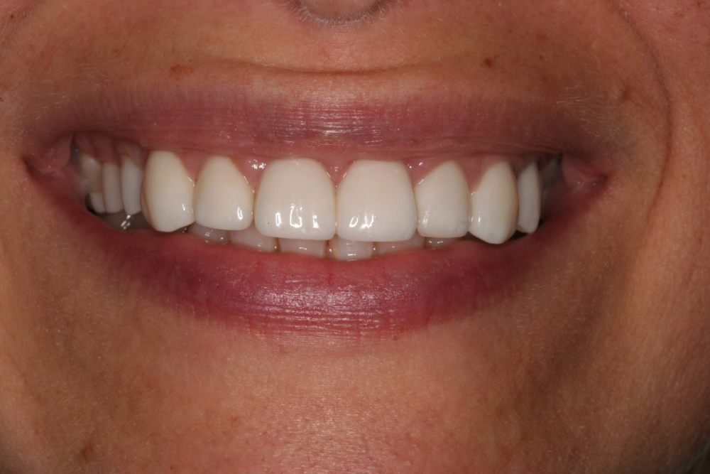 smile gallery after treatment case 2