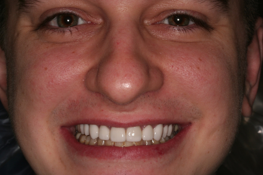 smile gallery after treatment case 3