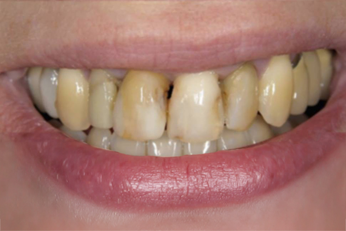 smile gallery before treatment case 1