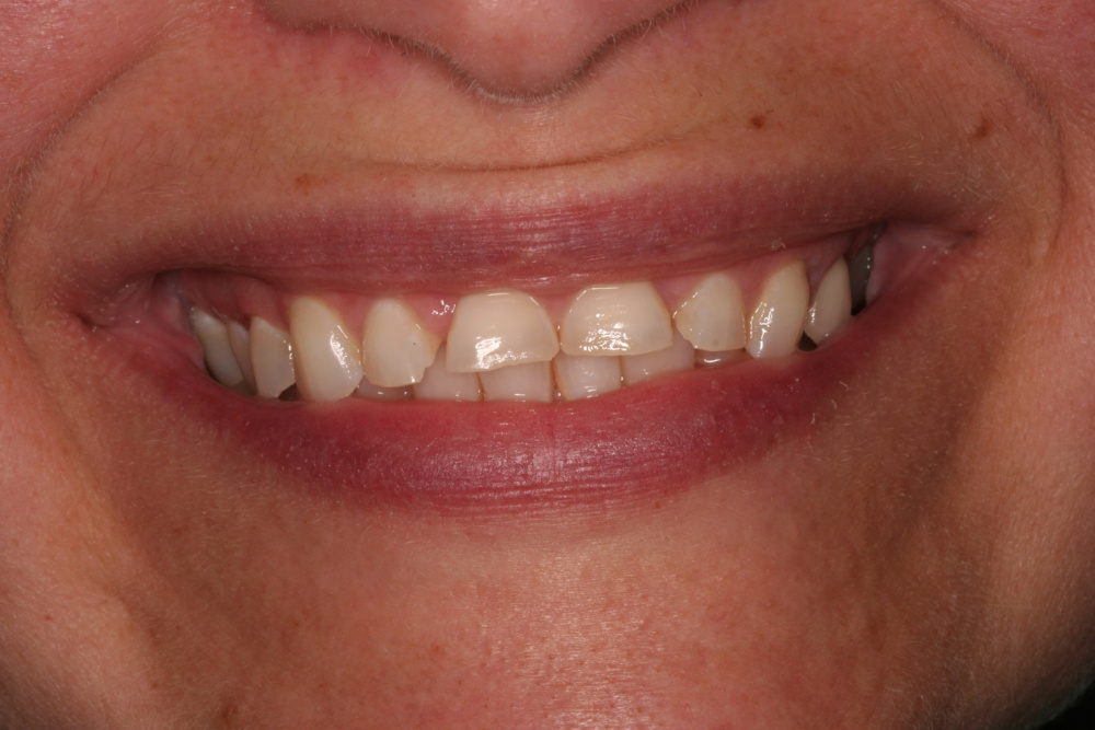 smile gallery before treatment case 2