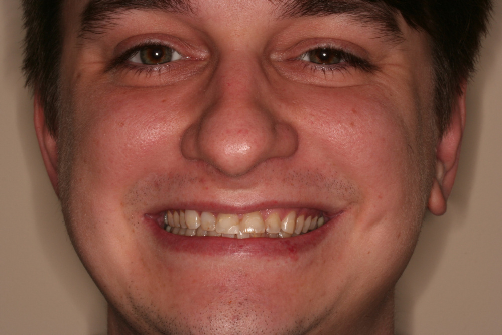 smile gallery before treatment case 3